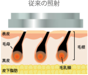 従来の照射