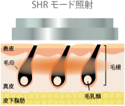 SHRモード照射